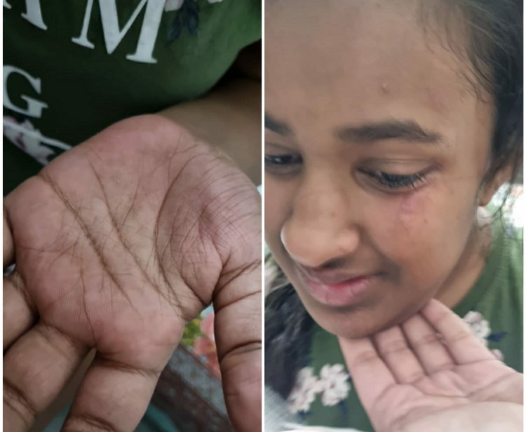 आवारा कुत्तों के हमले में छात्रा घायल